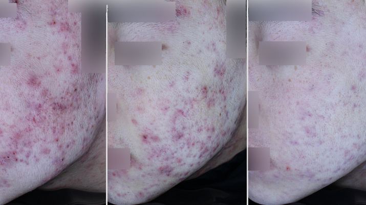 트러블성 피부 컨디션 케어 경과 예시